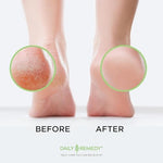 Close up of Daily Remedy callus gel precision applicator cap for easy use.