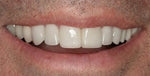 Jesse Dent DIY fake teeth set for natural looking dental restoration.