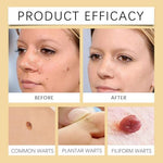 MORKORIA wart remover packaging showing 17 percent salicylic acid concentration