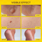 SupreH Botanical Skin Restore Cream tube included in the maximum strength wart kit.