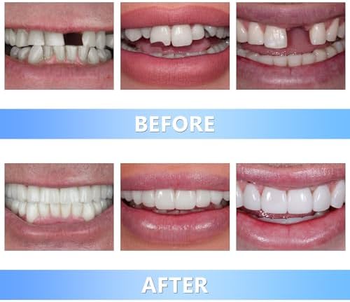 Applying custom moldable tooth to gap in teeth