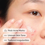 The Ordinary serum for pimple scars improving pimple marks removal daily