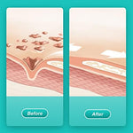Hydrating hydrogel wound dressing for autolytic debridement and necrotic tissue removal.