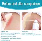 Compact adhesive remover spray for travel and mastectomy care.