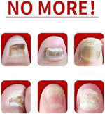 Natural botanical nail treatment providing assistance with restoring damaged nail plates