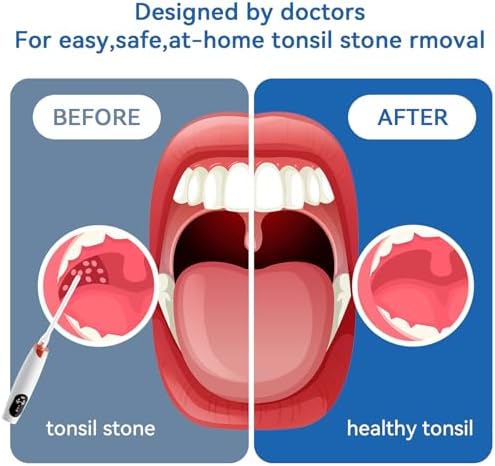 Adjustable suction power settings on iljimae tonsil stone device
