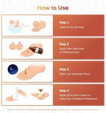 SupreH professional wart freeze off treatment for men and women imported from USA.