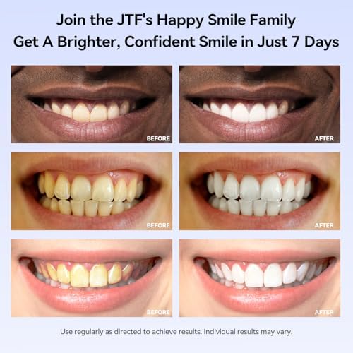 JTF teeth whitening kit package contents displaying the full six pack syringe setup for stain removal.