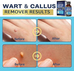MEOLY 40 percent salicylic acid formula for fast-acting wart removal