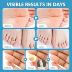 Step by step demonstration showing one step application of the targeted patch on a toe
