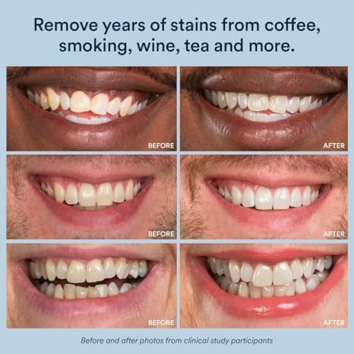 AuraGlow at-home teeth whitening gel syringes showing clear measurement markings