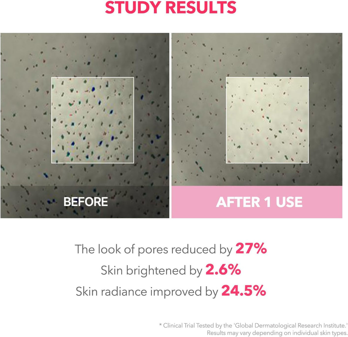 Before and after results of Aprilskin pore tightening mask treatment.