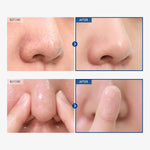 Tosowoong Azelaic Acid Serum being applied to soothe redness and balance oil production