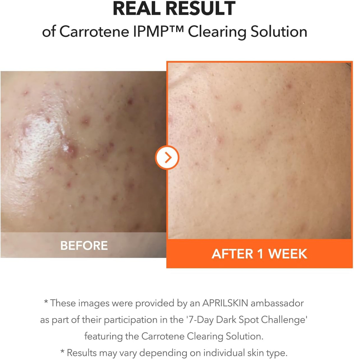 The dual tubes of the APRILSKIN Carrotene Clearing Solution arranged with the five sheet masks demonstrating full kit contents.