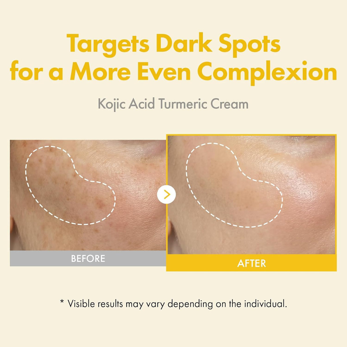 Real Turmeric Kojic Acid Serum dropper bottle highlighting brightening ingredients