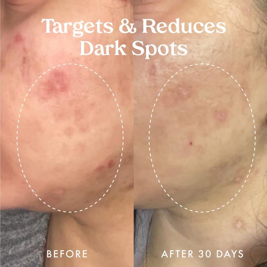 Kopari Vitamin C facial serum for hyperpigmentation and uneven skin tone