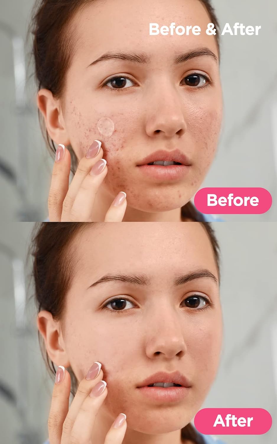 DERMALOGY by NEOGENLAB A-CLEAR SOOTHING ACNE CARE (1 PACK) - Image 7
