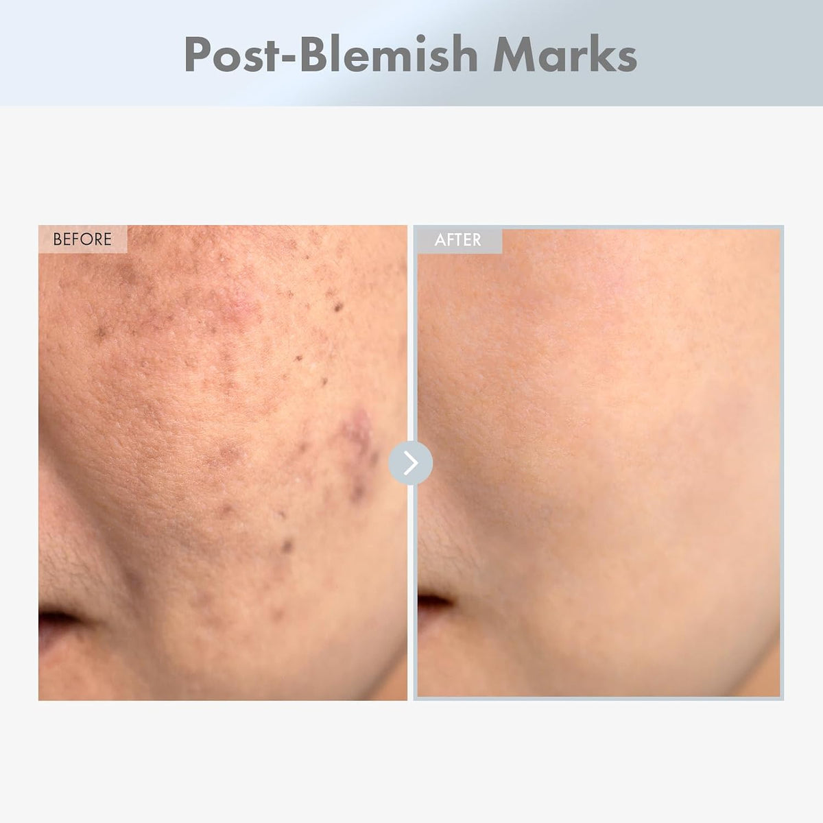 Korean skincare routine using Tosowoong brightening serum and dark spot cream