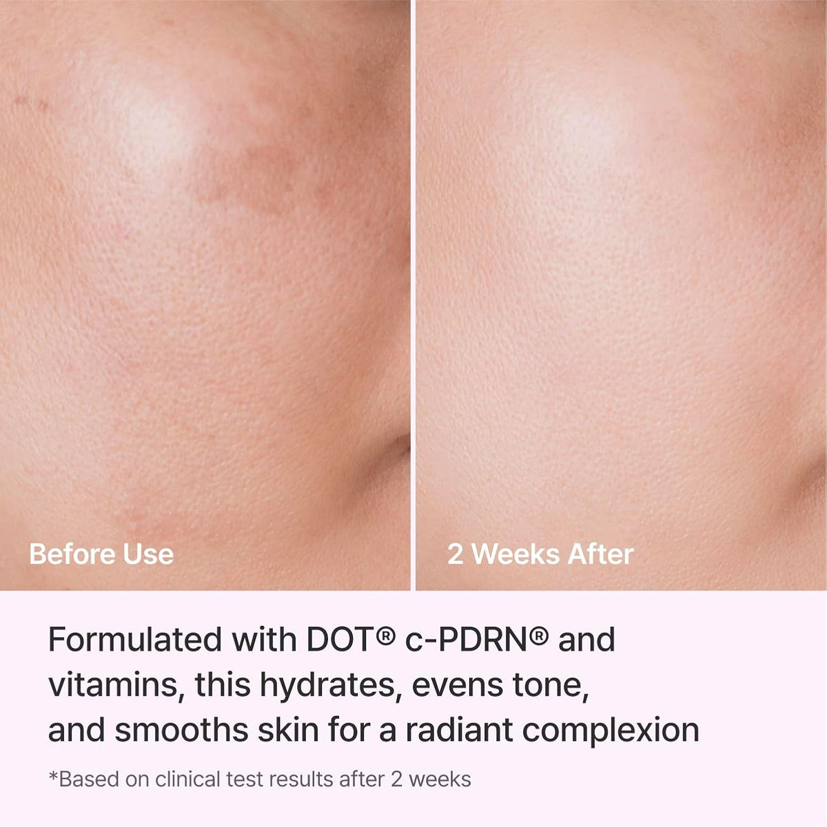 Applying Rejuran Triple Radiance Cream to skin