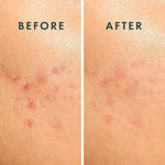 Rael vegan and cruelty free hydrocolloid acne strips for multi-spot blemish coverage.