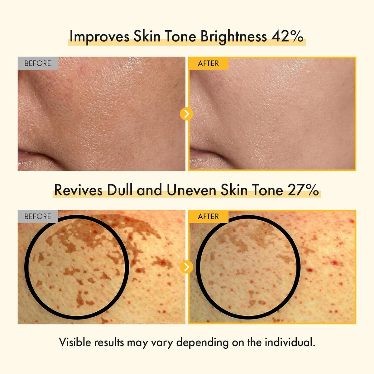Authentic TOSOWOONG hyperpigmentation cream imported to India for even skin tone