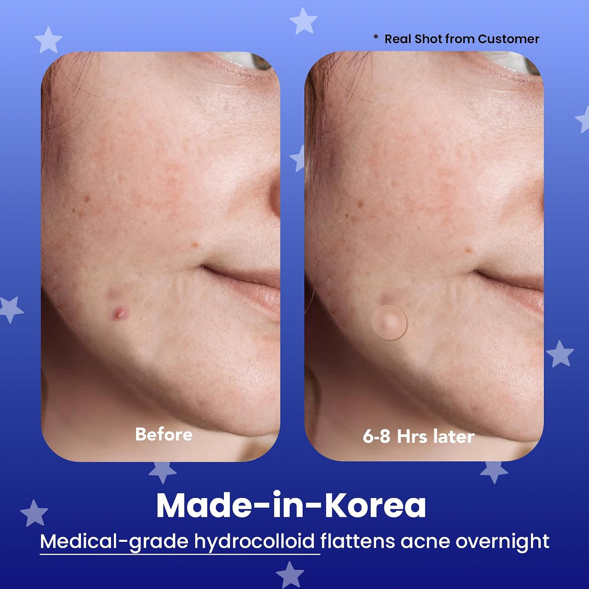 Avarelle Hydrocolloid Pimple Patches sheet showing 12 mm and 14 mm acne dots