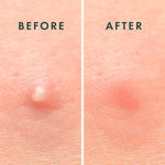 Close up of Rael overnight blemish patches highlighting extra adhesion properties