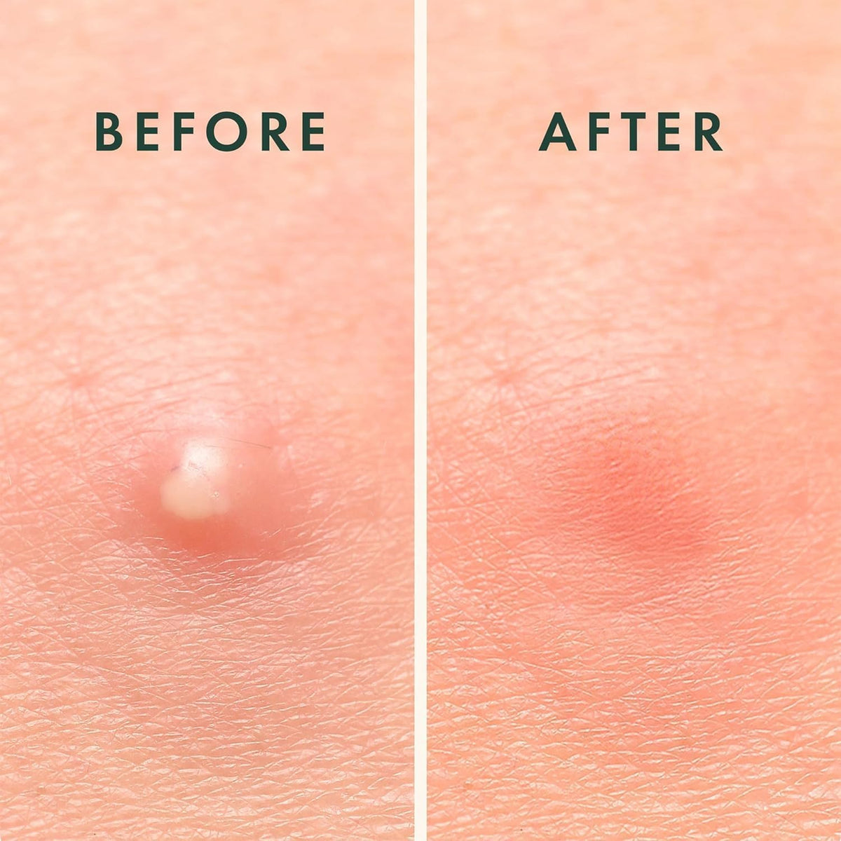 Close up of Rael overnight blemish patches highlighting extra adhesion properties