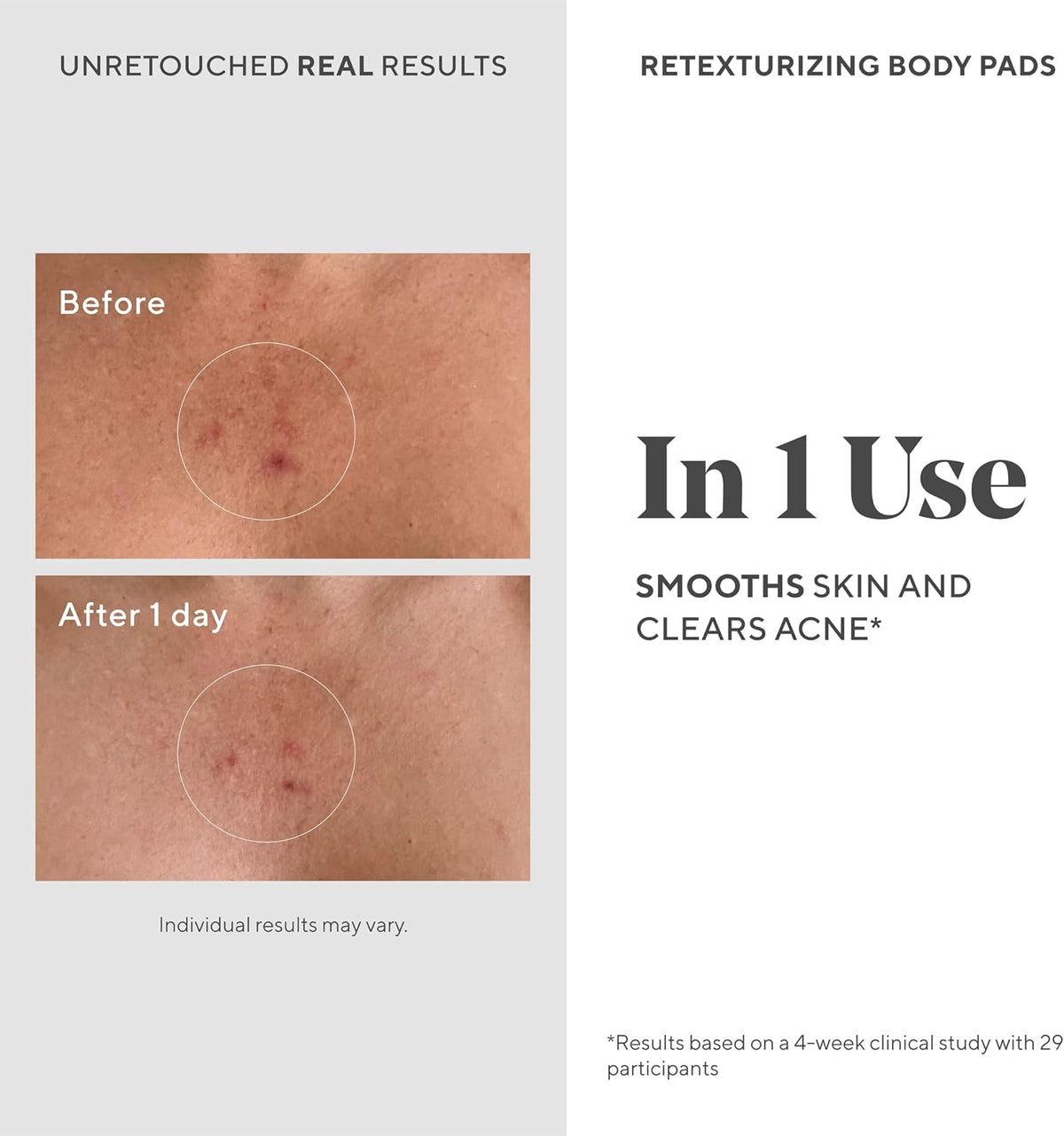 Murad blemish control body pads with salicylic acid for clearing breakouts