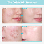 Texture of Tosowoong Zinc Oxide 10 Cream for acne