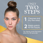 Model wearing translucent microdart patch on face for blemish care