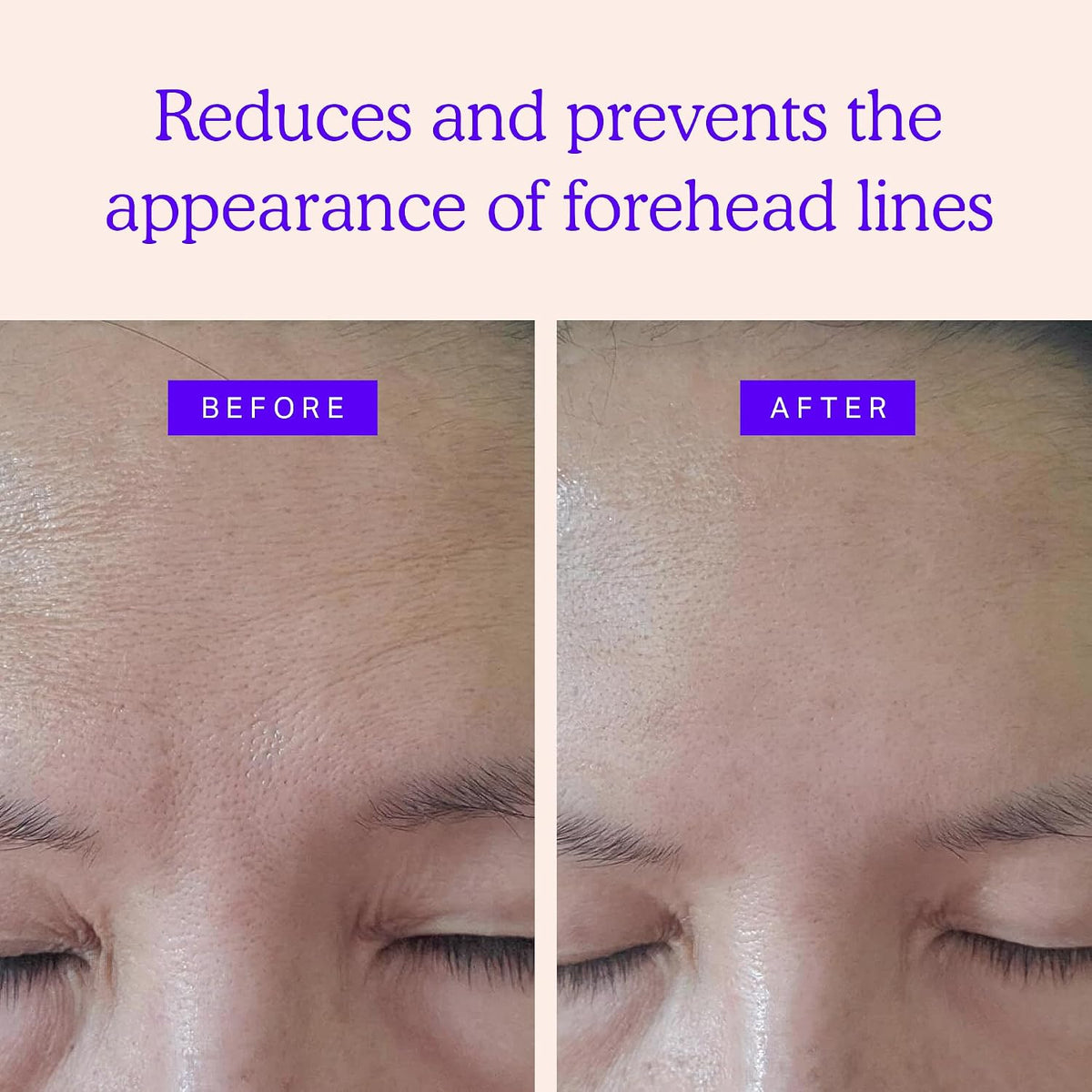 BLUMBODY Forehead Wrinkle Patches - Anti-Wrinkle Facial Patches to Smooth Fine Lines on Forehead & Between Eyes - Non-Silicone Face Tape - Comfortable Overnight Use (Up to 60-Day Supply) - Image 2