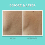 Bliss Clear Genius full kit layout for a complete acne-fighting skincare routine.