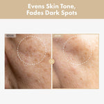 Dermatologist tested hyperpigmentation cream and soothing toner set for clearing stubborn acne scars.