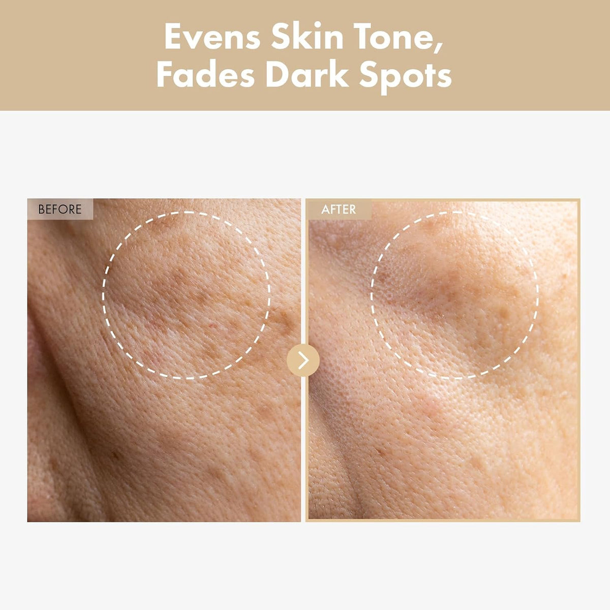 Dermatologist tested hyperpigmentation cream and soothing toner set for clearing stubborn acne scars.