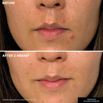 Kate Somerville EradiKate maximum strength blemish gel for clearing dark spots