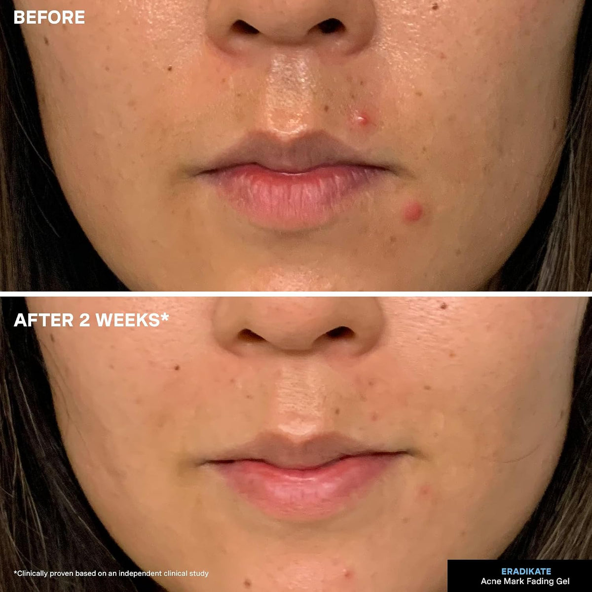 Kate Somerville EradiKate maximum strength blemish gel for clearing dark spots