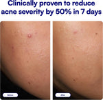 Bliss Clear Genius Acne Spot Treatment tube and box