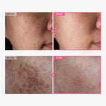 Tosowoong Arbutin 7.0 plus TXA 4.0 Cream packaging details for melasma
