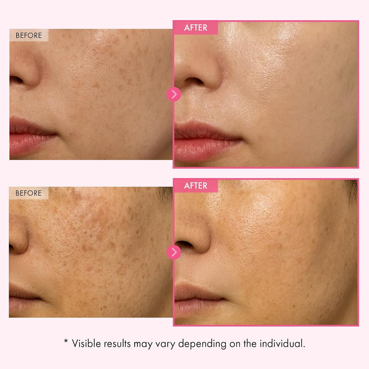 Lightweight texture of Tosowoong blemish and freckle removal facial moisturizer
