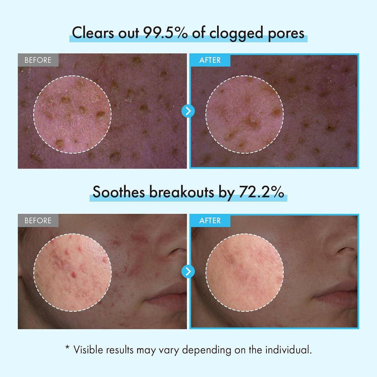 Korean skincare foaming cleanser for acne prone skin being lathered in hands