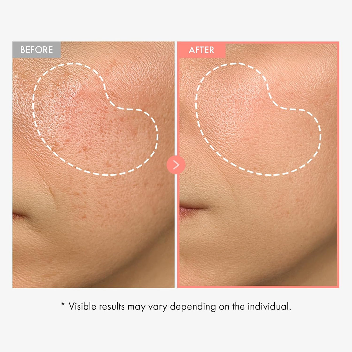 Korean skincare pink serum with alpha arbutin and vitamin b12 for uneven tone