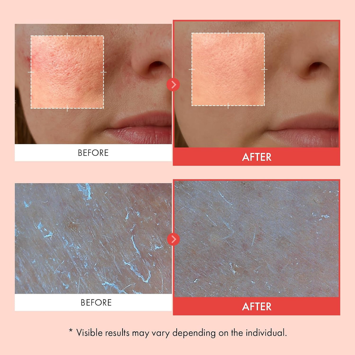 TOSOWOONG premium K-beauty resurfacing bundle for minimizing bumpy skin texture