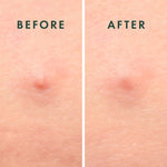 Rael USA imported blemish patches showcasing the dissolving microcrystal design