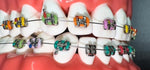 Artman Instruments orthodontic ties being applied to dental brackets.