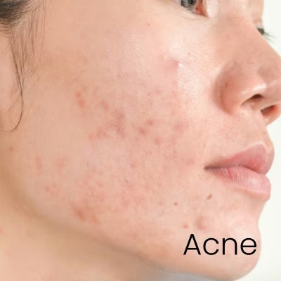 The Ordinary Acne