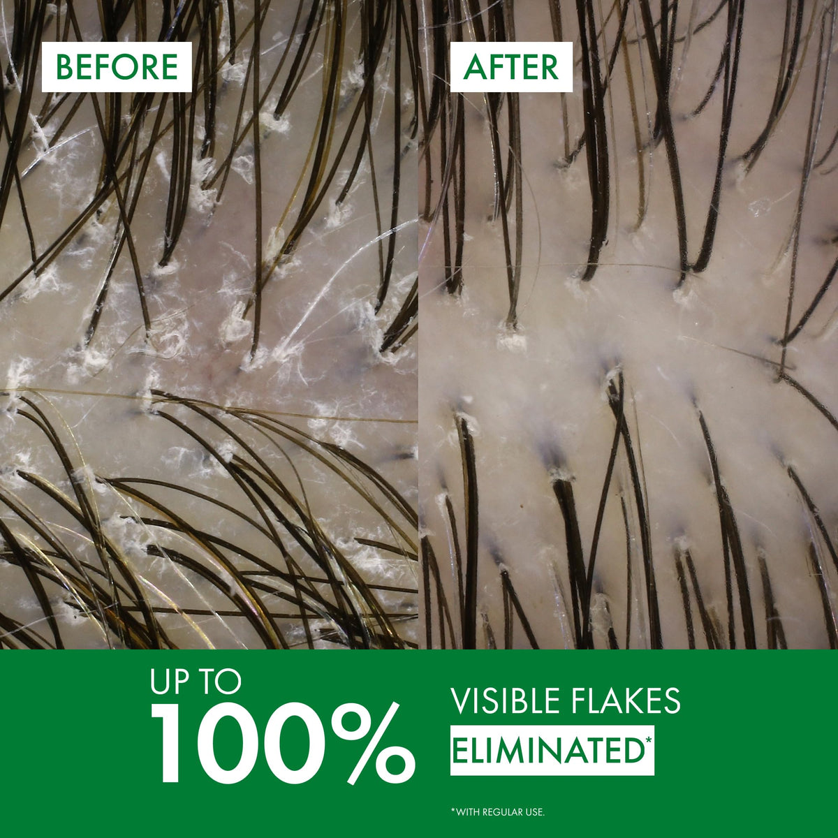 Imported Vichy Dercos dry scalp shampoo for severe dandruff relief