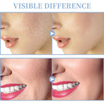 Tumakou handheld wand tongue tube for targeted acne treatment