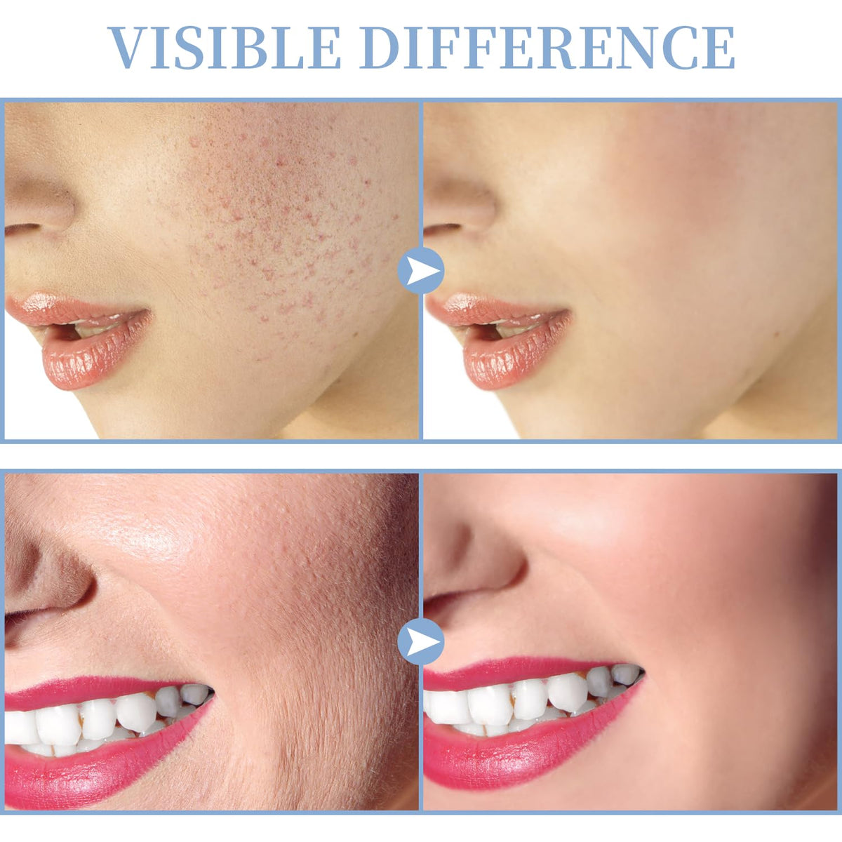 Tumakou handheld wand tongue tube for targeted acne treatment