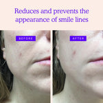 BLUMBODY non silicone face patches applied around the mouth to smooth laugh lines